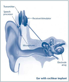 Cochlear Implant Surgery, Cochlear Implants,  Cochlear Implant Operation, Cochlear Implant